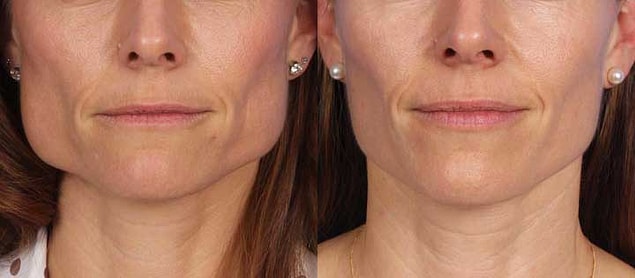 Masseter botoksu kimler yaptırabilir?