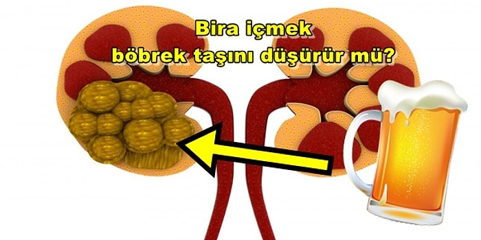 Bende Olmaz Demeyin! Böbrek Taşı ile İlgili En Merak Edilen Sorular ve Cevapları