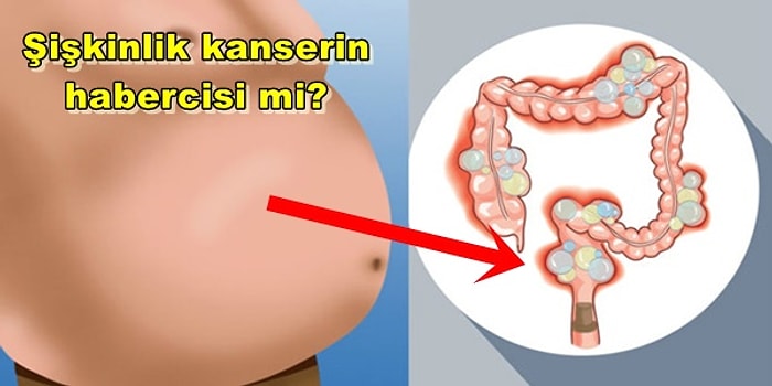 Mide Kanseri ve Belirtileri Hakkında En Çok Merak Edilen Sorular ve Cevapları