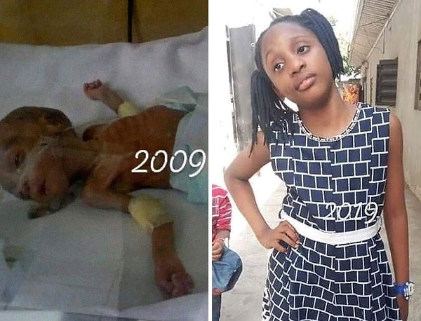 1. 10 лет назад эта девочка родилась недоношенной на сроке в 6 месяцев, весила 0,7 кг и провела в инкубаторе 3 месяца. Сейчас она выглядит абсолютно здоровой.