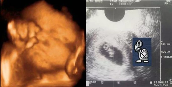 Криповые изображения, которые точно не ожидаешь увидеть на снимках с УЗИ