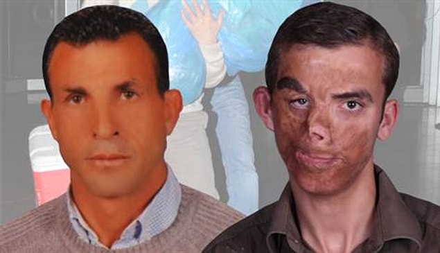 2012: Türkiye'de ilk yüz nakli gerçekleştirildi.