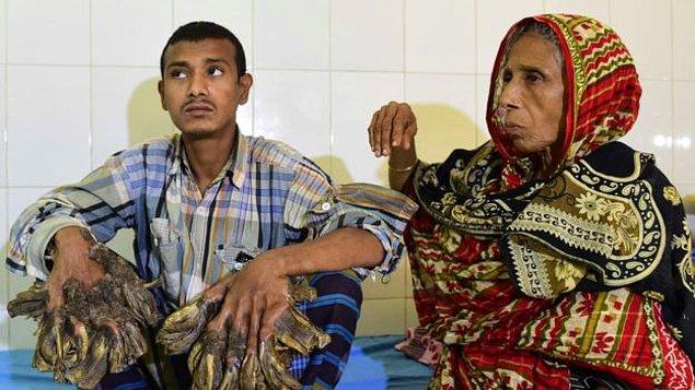 Başbakan Şeyh Hasina, Bajandar ülkenin sempatisini kazandığı için ona tedavi masraflarının karşılanacağı sözü vermişti.