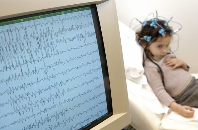 10. Epilepsi hastalığı nasıl tedavi edilir?