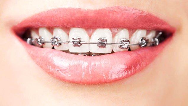 Hepimiz bugüne kadar dişlerdeki yerleşim bozukluklarıyla ilgili tek çözümün diş telleri olduğunu zannediyorduk.