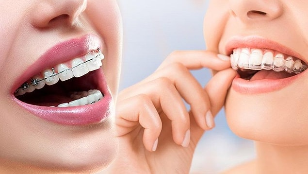 Günümüzde, gelişen teknoloji ve tıp sayesinde bu tellerin ve braketlerin yerini şeffaf plaklar aldı.