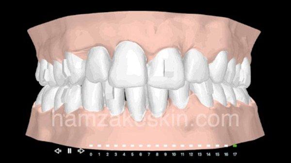 Şeffaf plak tedavisinde önce ağız içi muayene ve sonrasında hastanın tedaviye uygunsa ağız içinden ölçü alınarak dişlerin dijital ortama aktarılması gerekiyor.