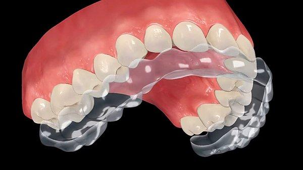 Şeffaf plak tedavisi, iskeletsel olarak problemi olmayan ve dişlerindeki çapraşıklık miktarı aşırı fazla olmayan hastaların % 80, %90'ına uygulanabilir.
