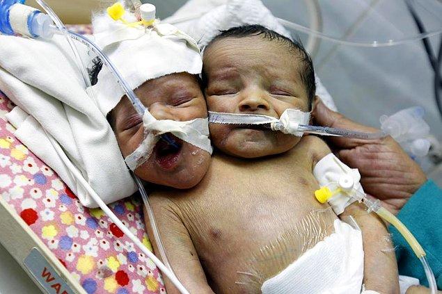 Abdul-Khaliq ve Abdul-Rahim isimli ikiz kardeşler ocak ayında Yemen'de doğdular.