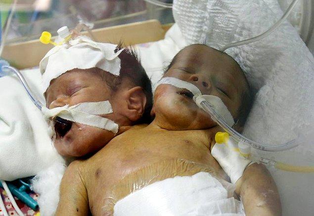 İkizler doğumlarından sonraki ilk birkaç gününü Al-Thawra Hastanesi'nde yoğum bakımda geçirdiler. Kuvözde kaldıkları bu günlerde oldukça güçlü duruyorlardı.
