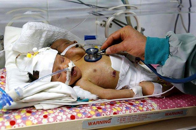 Buradaki tıbbi yeterlilik özellikle savaş sırasında azdır. Doktorlar bebeklerin buna direnç gösteremeyeceğinden korkuyorlar.