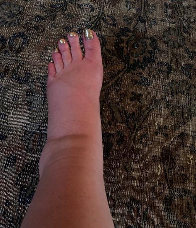 She shared a photo of her swollen feet on her Instagram and ask for help from followers!