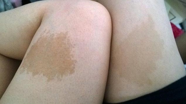 10. “When I met my wife, it turned out we had similar looking birthmarks on our thighs.”