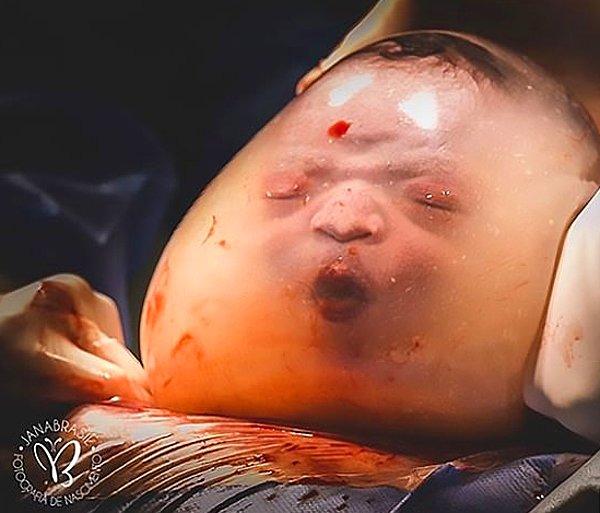 Anne Monyck Valasco 100 bin de 1 görülen bir durum yaşadı, doğum yaptı ve bebeği kesesi ile birlikte doğdu.