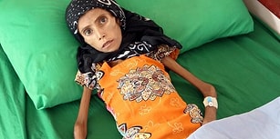 Bu Acıtan Kare Dünyanın Kör ve Sağır Kaldığı Yemen'den: 10 Kilo Ağırlığındaki Çocuk Tedavi Altına Alındı