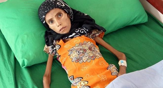 Bu Acıtan Kare Dünyanın Kör ve Sağır Kaldığı Yemen'den: 10 Kilo Ağırlığındaki Çocuk Tedavi Altına Alındı