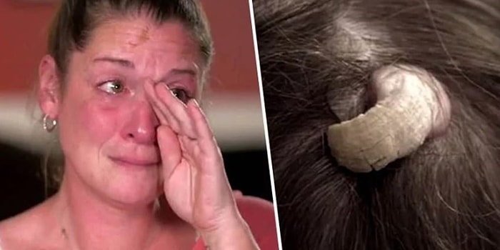 Tıp Dünyası Şoka Uğradı! Kafasının Arkasında Boynuz Çıkan Kadın