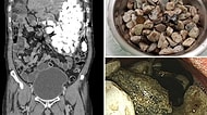 Karın Ağrısı Şikayetiyle Doktora Giden Adamın Midesinden 2 Kilogram Ağırlığında Yabancı Nesne Çıkarıldı!