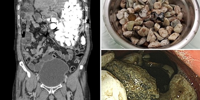 Karın Ağrısı Şikayetiyle Doktora Giden Adamın Midesinden 2 Kilogram Ağırlığında Yabancı Nesne Çıkarıldı!