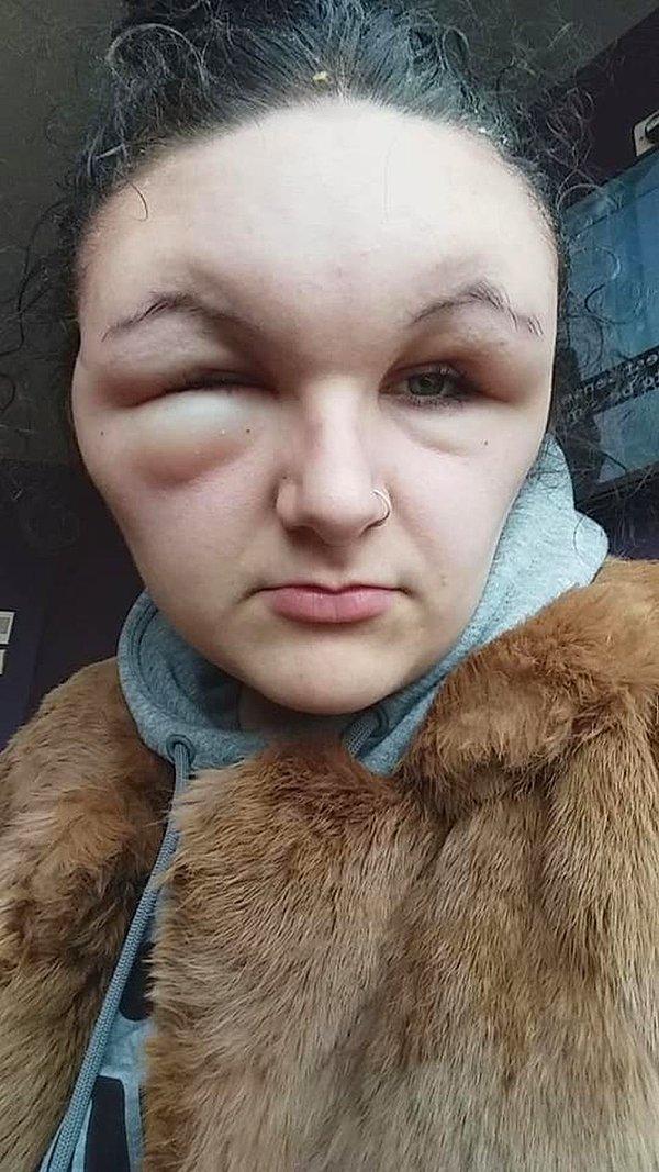 18 yaşındaki genç Georgina Paraskeva'nın yüzü, geçtiğimiz Kasım ayında saçını boyadıktan sonra iki katına kadar şişti.