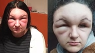 Saçlarını Boyadıktan Sonra Cildinin Gösterdiği Alerjik Reaksiyonla Tanınmaz Hale Gelen Genç Kız