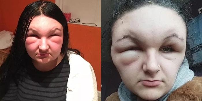 Saçlarını Boyadıktan Sonra Cildinin Gösterdiği Alerjik Reaksiyonla Tanınmaz Hale Gelen Genç Kız