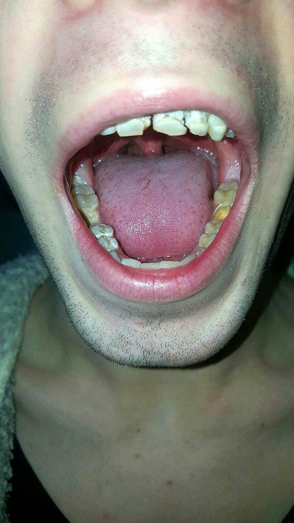 Diş hekimi, Pyner'ın ağzındaki bütün dişlerin çürük olduğunu söyledi. Pyner şimdi ağzındaki 24 dişe dolgu ve kırılan dört dişine protez yaptırmak için hazırlanıyor.