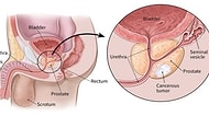 Erkeklerde Çok Sık Görülen Prostat Kanseri Hakkında Bilmeniz Gerekenler