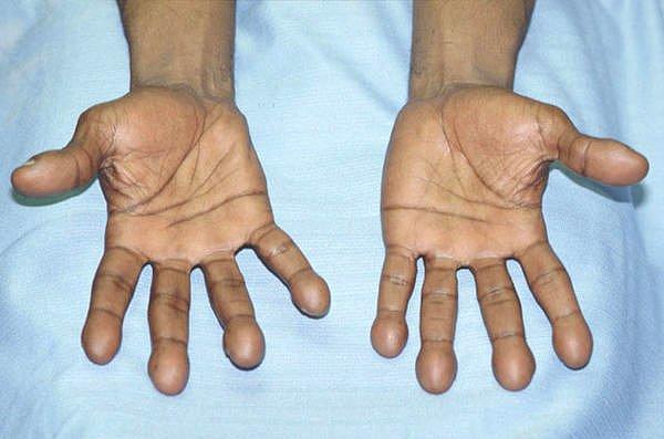 4. Büyüyen parmak uçları: Solunum yolları rahatsızlığı.