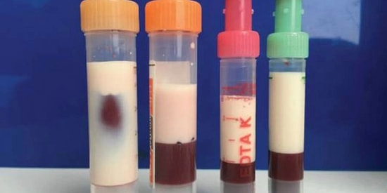 Doktorlar Bile Şaşkın: Aşırı Yüksek Yağ Oranı Nedeniyle Kanı Yoğun, Beyaz ve Süt Gibi Görünen Hasta