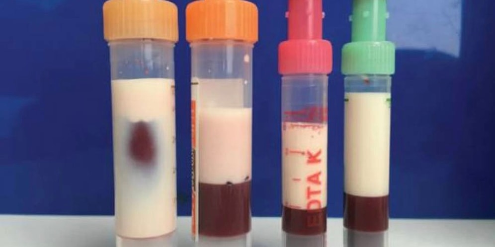 Doktorlar Bile Şaşkın: Aşırı Yüksek Yağ Oranı Nedeniyle Kanı Yoğun, Beyaz ve Süt Gibi Görünen Hasta