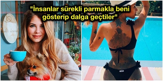"Daha Fazla Saklamayacağım" Vücudundaki Kocaman Doğum İzi Yüzünden Tüm Hayatı Boyunca Dalga Konusu Olan Kadın