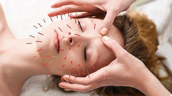 5. Akupunktur