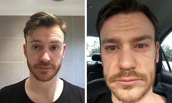 7. У этого парня аллергия. Он демонстрирует, как меняется его лицо, когда она обостряется