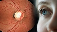 Sinsice İlerleyip Sizi Kör Edebilecek Glokom Hakkında Mutlaka Bilmeniz Gerekenler
