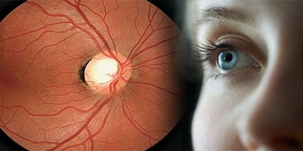 Sinsice İlerleyip Sizi Kör Edebilecek Glokom Hakkında Mutlaka Bilmeniz Gerekenler