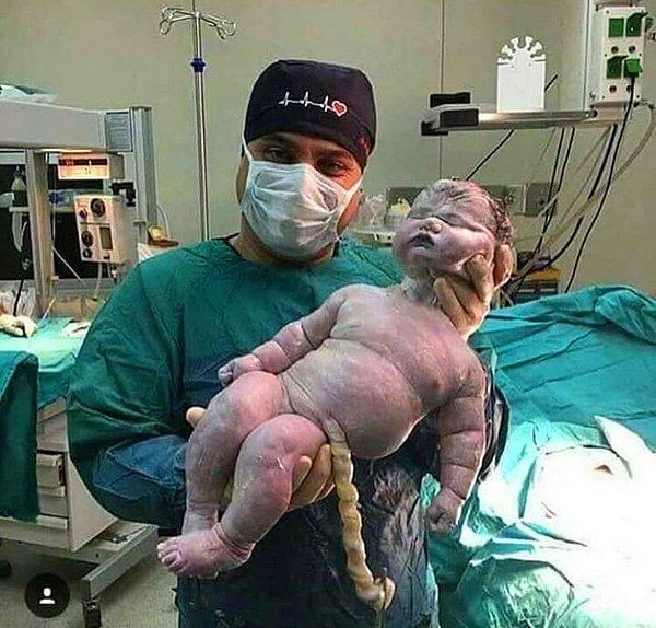 5. Doğal doğumla dünyaya gelmiş en büyük bebek! 7.9 kg ağırlığında ve 57.5 santimetre boyunda.