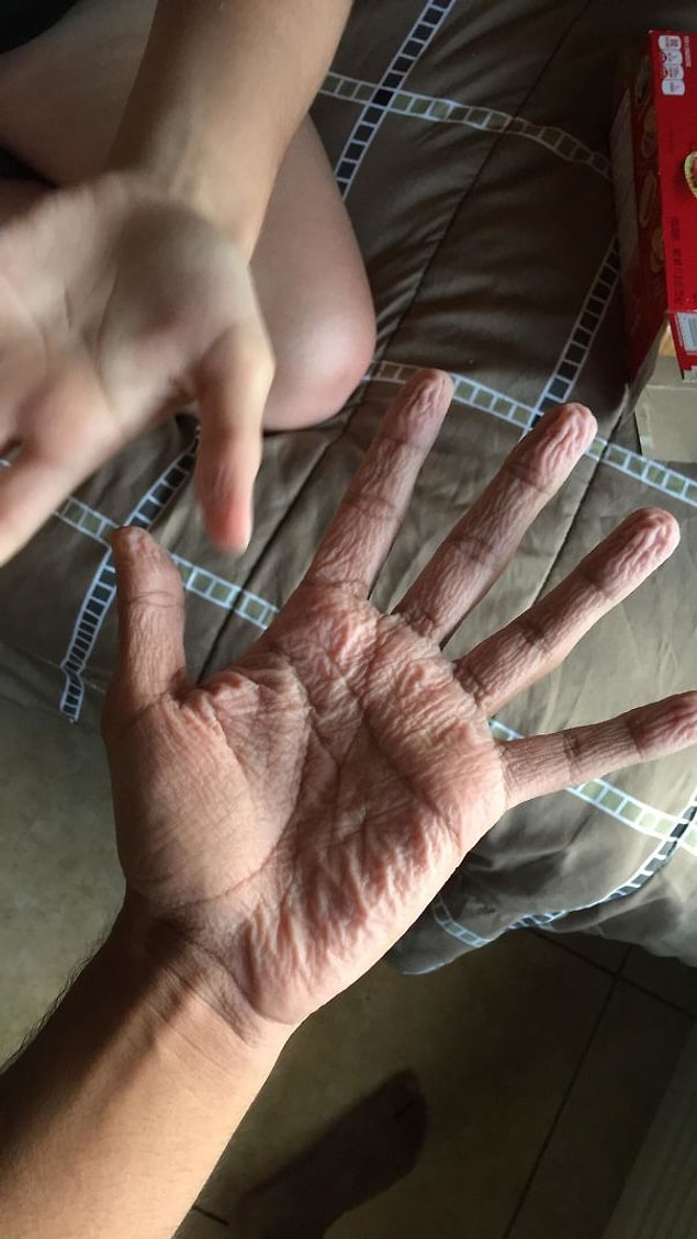 19. "Anormal bir şekilde buruşuk parmaklar mı? Ne zaman birileriyle yüzmeye gitsem ellerim herkesinkinden on kat fazla buruşuyor."