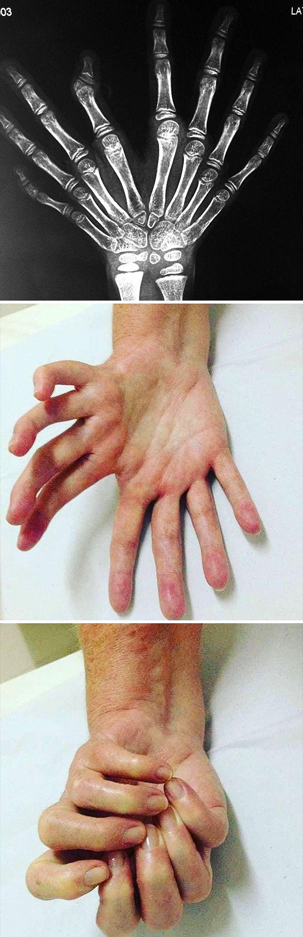 6. "Ulnar Dimelia Or Mirror Hand Syndrome"