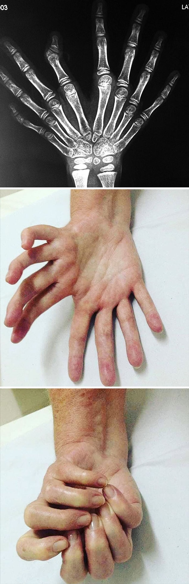 6. "Ulnar Dimelia Or Mirror Hand Syndrome"