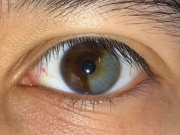 15. "My Left Eye Is About 1/3 Grey"