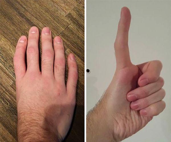 25. "Five Fingers, No Thumb"