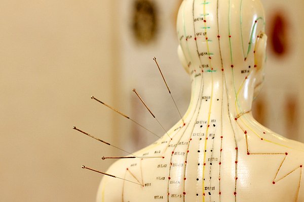 Dünya üzerinde iki farklı akupunktur türü uygulanır.