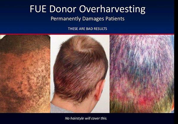 Daha geçen hafta 43 yaşında bir adam, Hindistan'da gerçekleştirilen 12 saatlik saç ektirme operasyonunun ardından hayatını kaybetti. Bu operasyon için 5.400 pound ödeme yapmıştı.