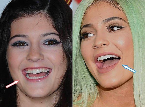 10. Kylie Jenner radikal değişiminde dişlerini de atlamamış.