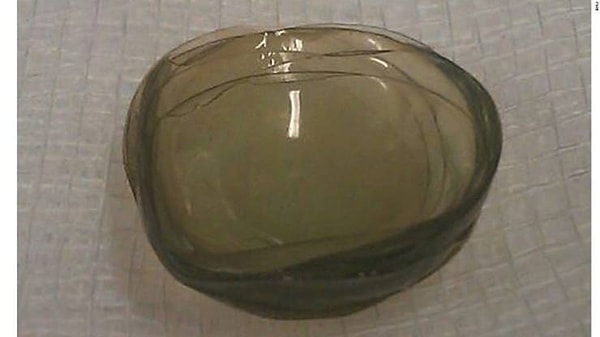 16. Врачи нашли 27 контактных линз в глазу женщины