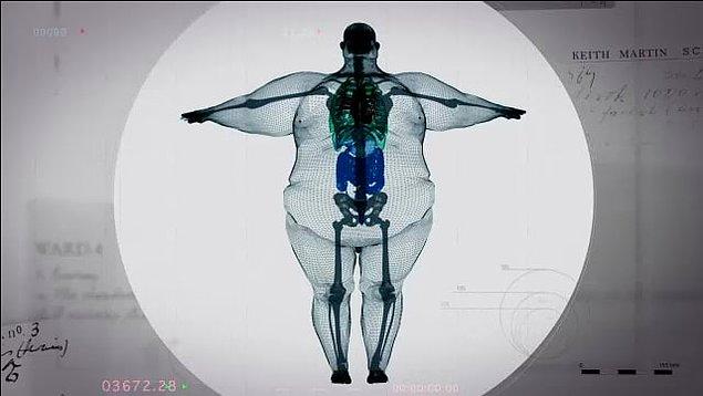 445 kg ağırlığında bir adamın röntgen görüntüsü Twitter üzerinden yayınlandıktan sonra viral oldu.