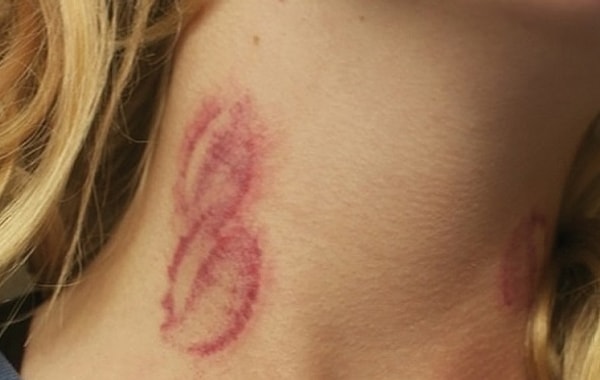 2. А засос вам когда-нибудь ставили?