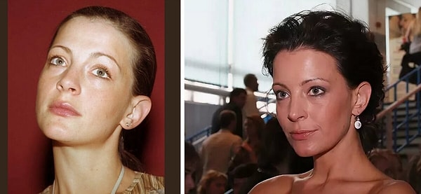 3. Евгения Крюкова делала отопластику - изменила оттопыренные уши