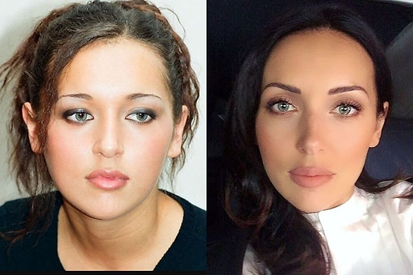 8. Алсу - одна из тех звезд, кто сделал ринопластику, а также, судя по всему, блефаропластику, и подняла скулы